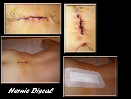 Hernie Discal